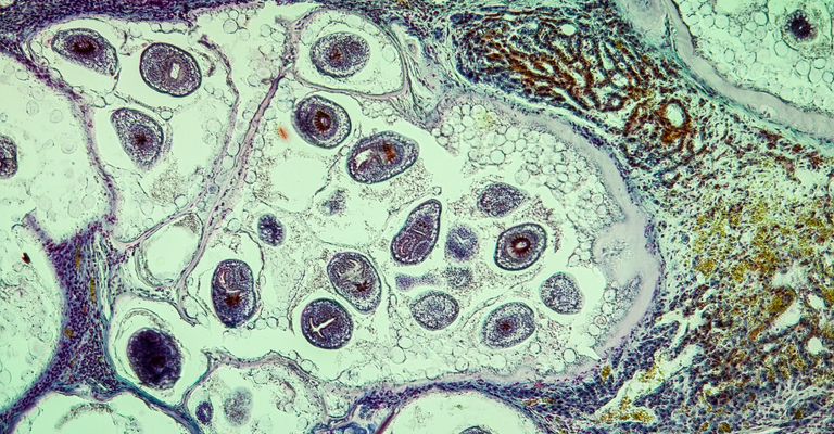 Worms in infected liver 100x Worms in infected liver 100x