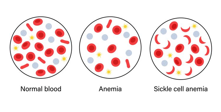 Normales Blut, Anämie und eine Probe mit Sichelanämie. Struktur der menschlichen Blutzellen. Thrombozyten, Leukozyten und Erythrozyten unter dem Mikroskop. Mikrobiologie-Test Vektor-Illustration für die Klinik